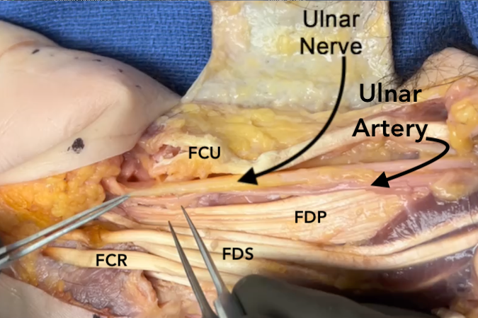 Ulnar Nerve Anatomic Structures At Risk